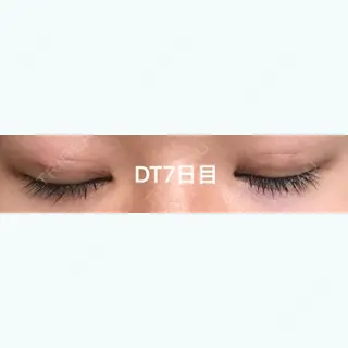 7日目の経過画像（2枚目）