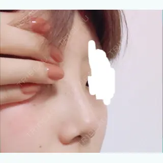 65日目の経過画像（1枚目）
