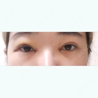 4日目の経過画像（1枚目）