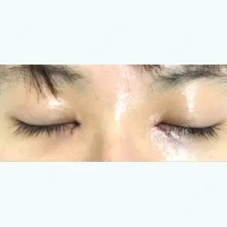 1日目の経過画像（2枚目）