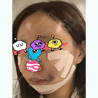4日目の経過画像（2枚目）