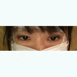 0日目の経過画像（1枚目）
