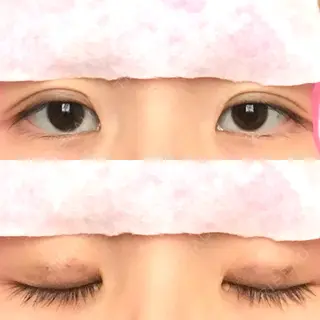 3日目の経過画像（1枚目）