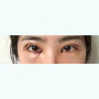2日目の経過画像（1枚目）
