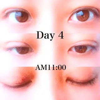 3日目の経過画像（1枚目）