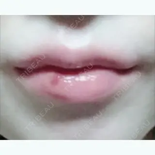 6日目の経過画像（2枚目）