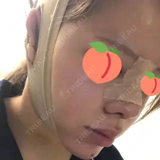 2日目の経過画像（1枚目）