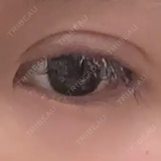 0日目の経過画像（2枚目）