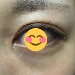 108日目の経過画像（2枚目）