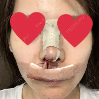 0日目の経過画像（3枚目）