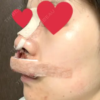 0日目の経過画像（1枚目）
