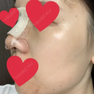 1日目の経過画像（1枚目）