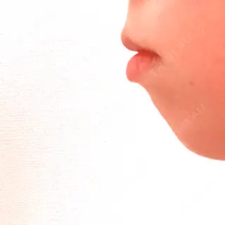 4日目の経過画像（1枚目）