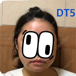 5日目の経過画像（1枚目）