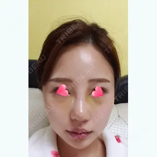 7日目の経過画像（1枚目）