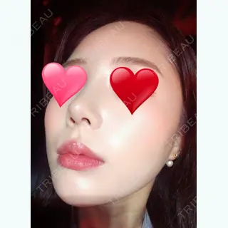60日目の経過画像（1枚目）