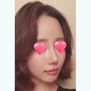 92日目の経過画像（1枚目）