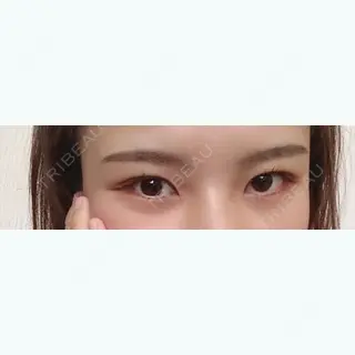 182日目の経過画像（2枚目）