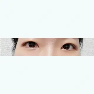 5日目の経過画像（1枚目）