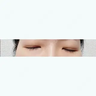 5日目の経過画像（2枚目）