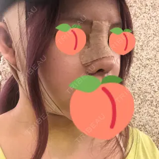 4日目の経過画像（2枚目）