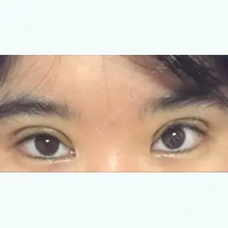 6日目の経過画像（1枚目）