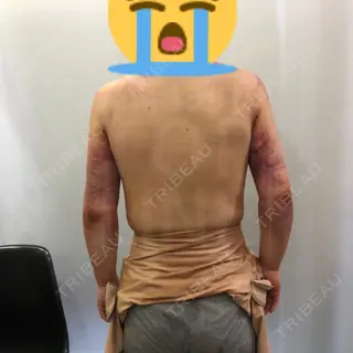 0日目の経過画像（1枚目）