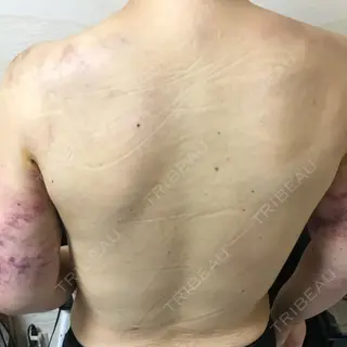 2日目の経過画像（1枚目）