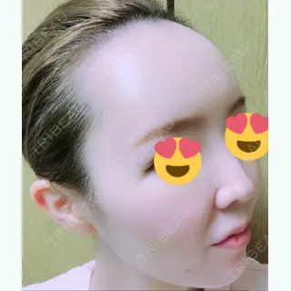 8日目の経過画像（1枚目）