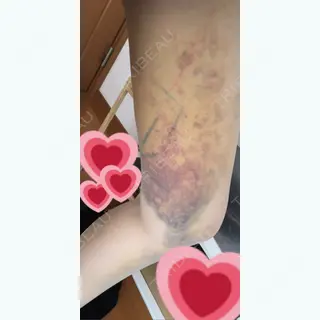6日目の経過画像（3枚目）