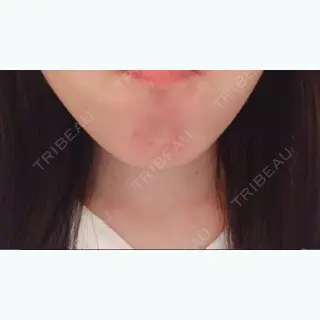0日目の経過画像（2枚目）