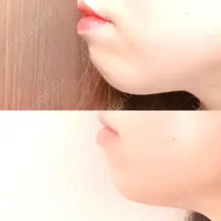 5日目の経過画像（2枚目）