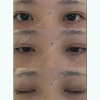 31日目の経過画像（1枚目）