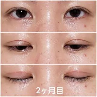 60日目の経過画像（1枚目）