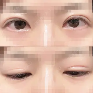 34日目の経過画像（1枚目）