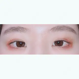 6日目の経過画像（2枚目）