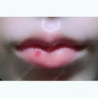 10日目の経過画像（1枚目）
