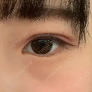 17日目の経過画像（1枚目）