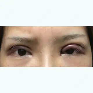 0日目の経過画像（1枚目）