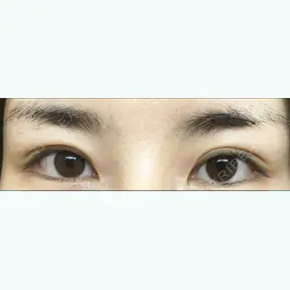 44日目の経過画像（1枚目）