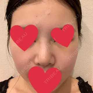 5日目の経過画像（3枚目）