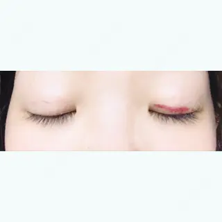 12日目の経過画像（2枚目）