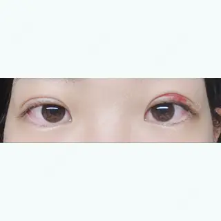 12日目の経過画像（3枚目）