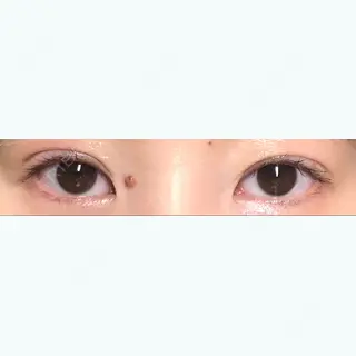 16日目の経過画像（1枚目）