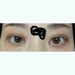 32日目の経過画像（1枚目）