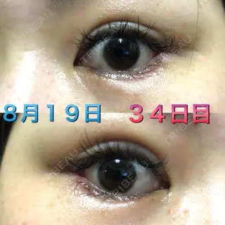 34日目の経過画像（2枚目）