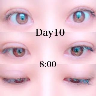10日目の経過画像（1枚目）