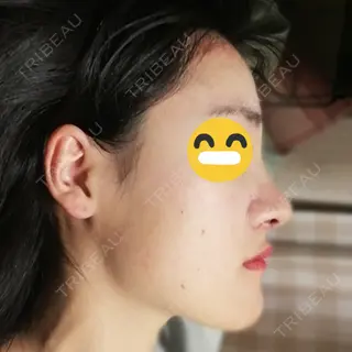 6日目の経過画像（1枚目）