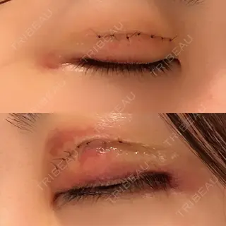 2日目の経過画像（2枚目）