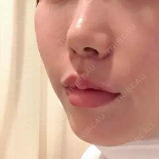 7日目の経過画像（3枚目）